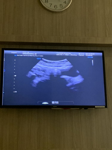 วันนี้ไปอัลตราซาวด์ครั้งแรกมาครับ