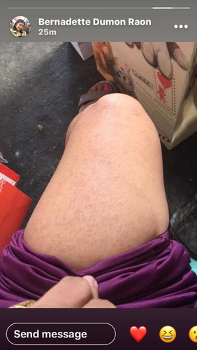 Rashes