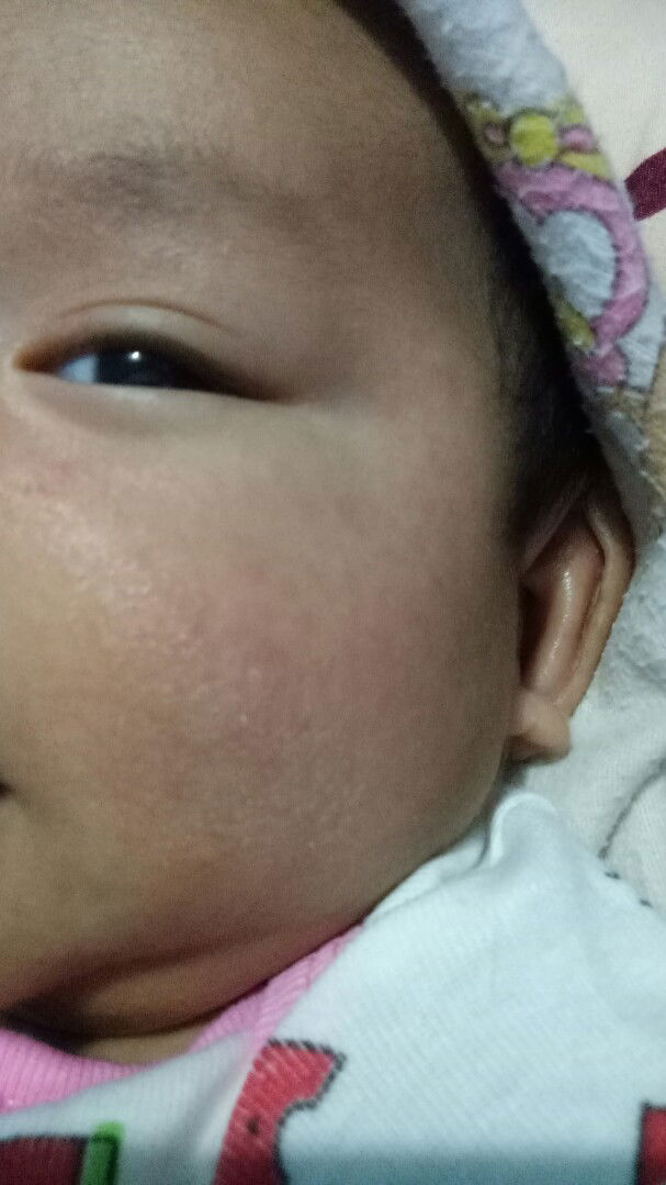 bintik2 merah pada wajah dan perut