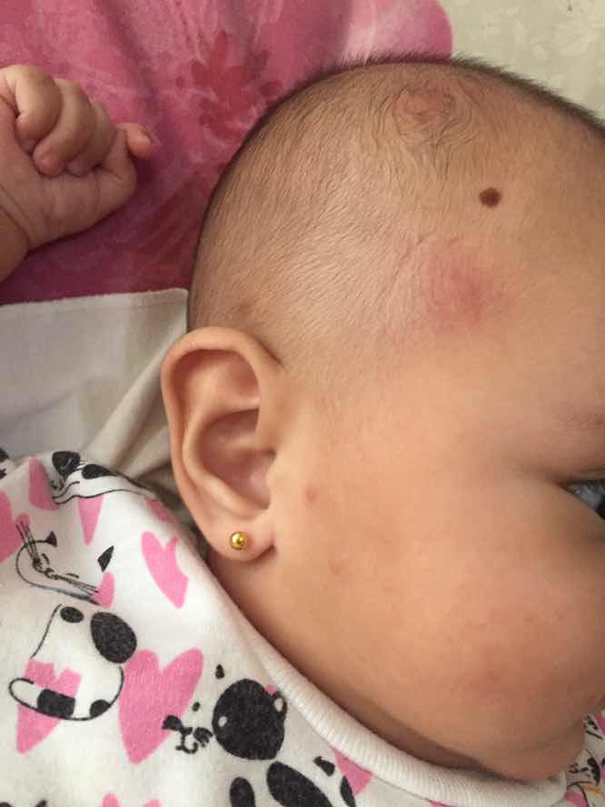 cara menghilangkan bentol