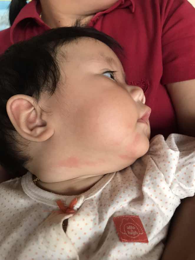 ตุ่มผื่นขึ้นแบบนี้คืออาการแพ้หรือเปล่าค่ะ