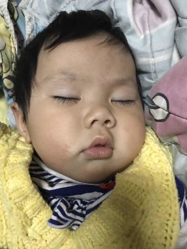 แก้มเริ่มแตกแล้ว