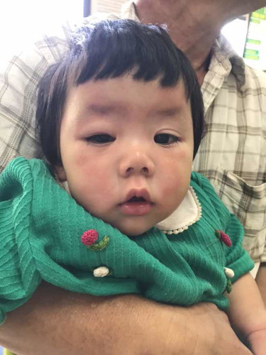 น้องแพ้ขั้นรุนแรง