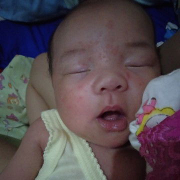 bintik-bintik merah di wajah anak