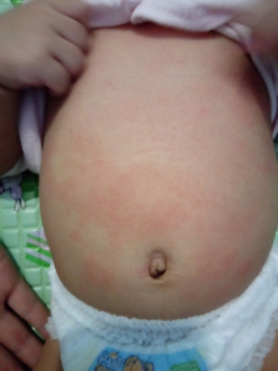 merah" di kulit perut bayi