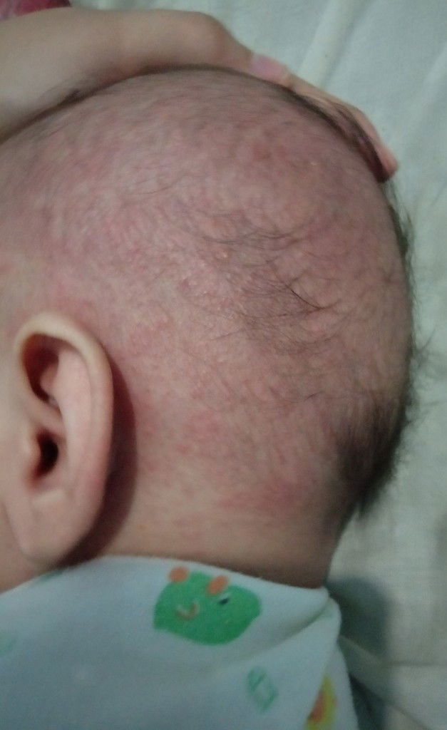Bintik" merah dikepala & belakang telinga bayi