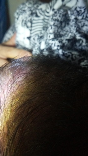 Bolehkah dibersihkan ? (seputar kulit kepala bayi usia 27 hari gm ya ? )