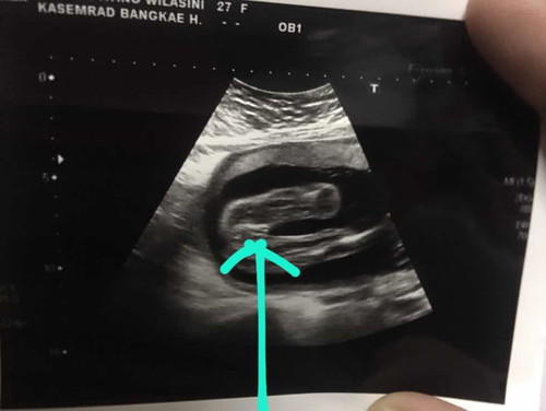 อัลตร้าซาวด์