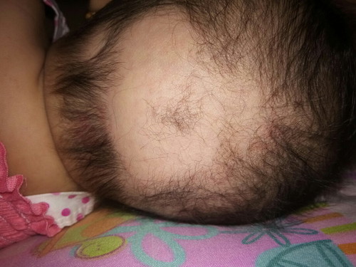 naglalagas na buhok ng baby