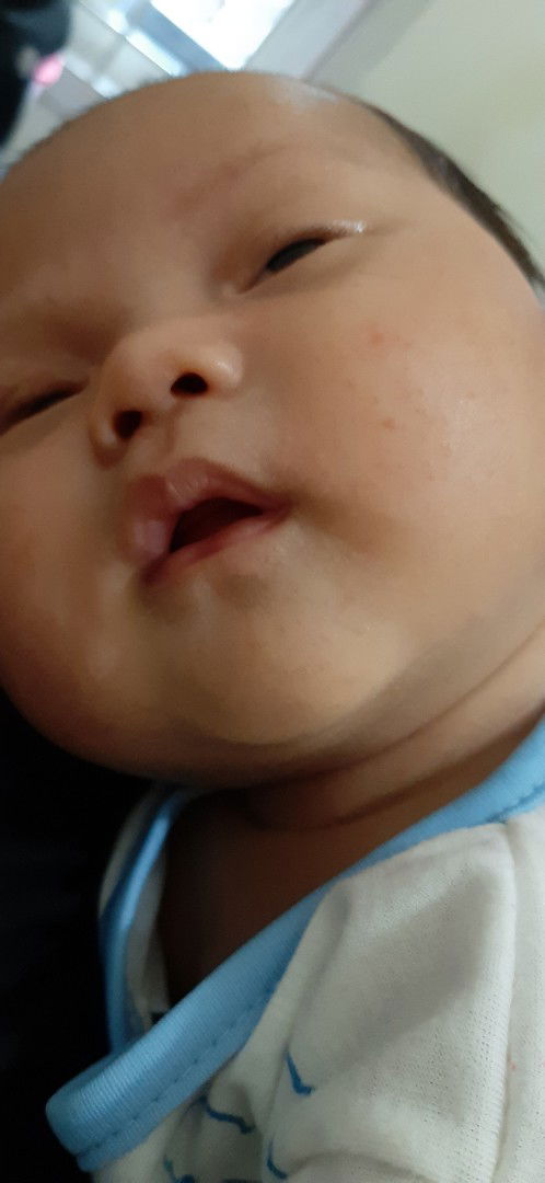 muka bayi beruntusan