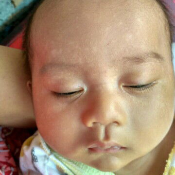 bintik putih di wajah bayi