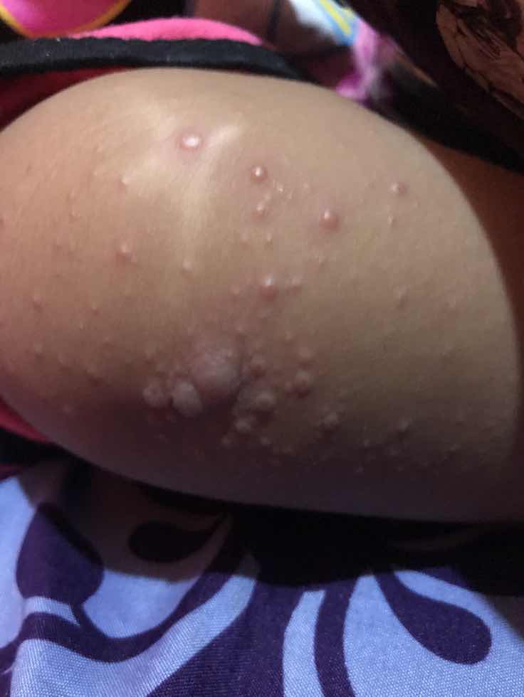 Bentol sekujur tubuh