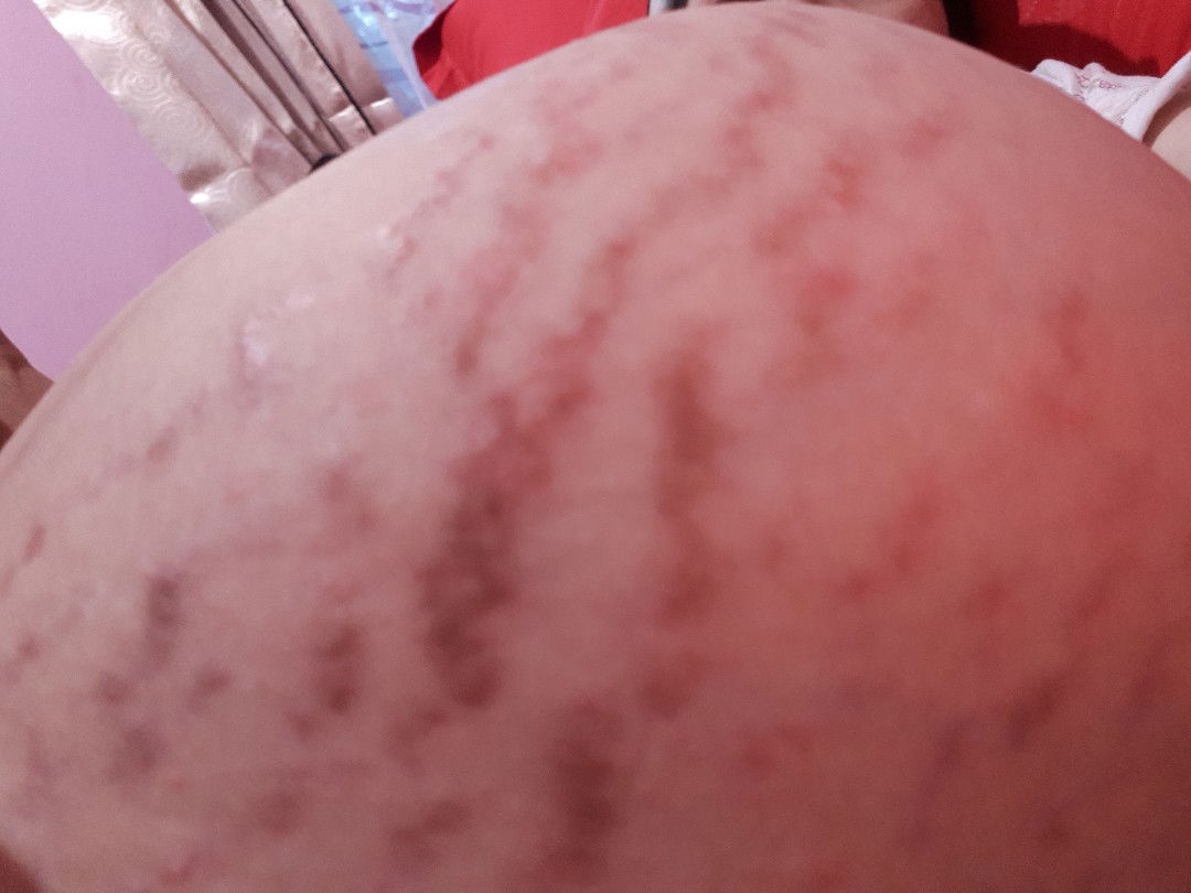Bintik2 merah pada stretch mark perut bumil