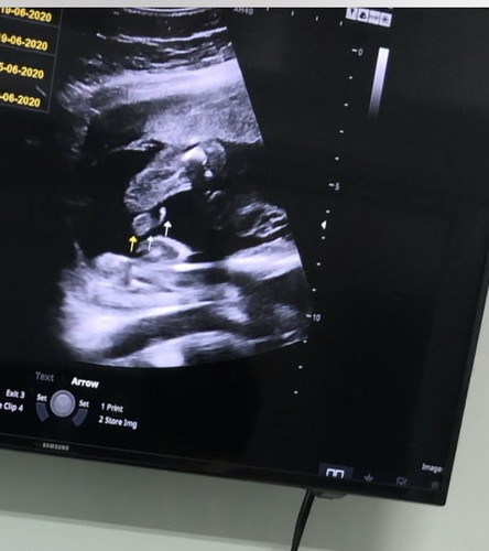 ใครกำหนดคลอดเดือนมิถุนายน บ้างค่ะได้ญ หรือ ช?