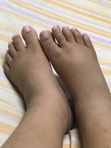 เท้าบวม