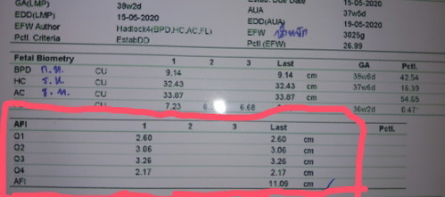 ครรภ์แฝดน้ำ