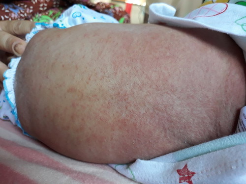 ลูกใคเปนผื่นแบบนี้บ้างค่ะ ลูกเราเปนผื่นแดงๆแบบนี้อยู่คอ อยู่หลังเยอะมาก