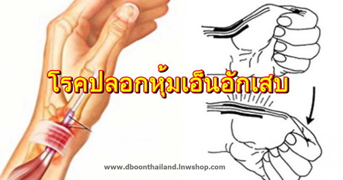 เป็นโรคปลอกหุ้มเอ็นอักเสบ