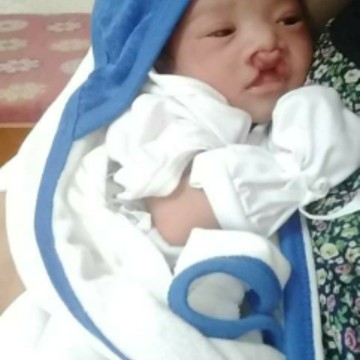 cleft lip