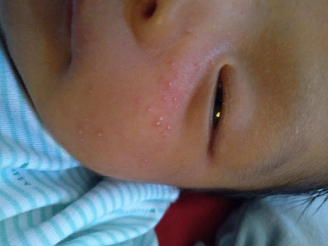bintik2 di pipi