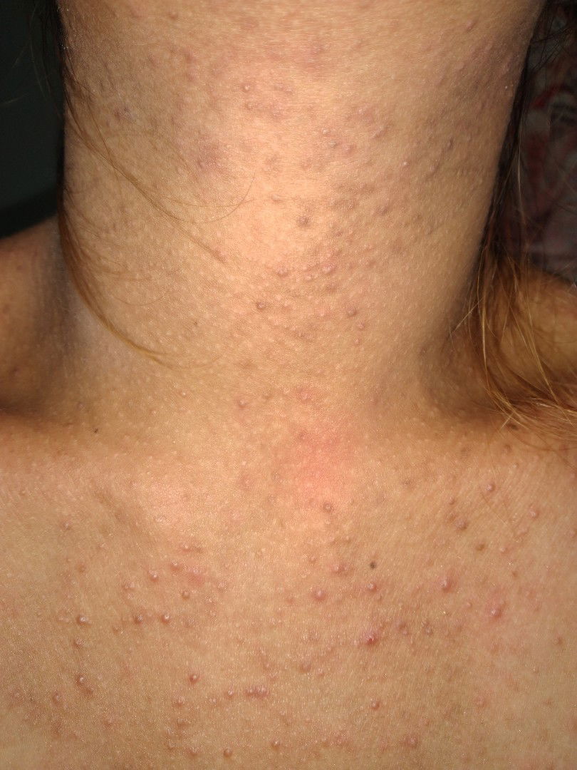 เป็นผดผื่นที่คอ หน้าอก และหลัง