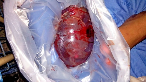 เบาหวานก่อนตั้งครรภ์