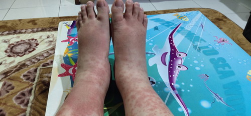 Edema & PUPPP