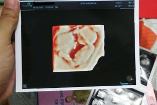 Usg Ke 3 (kemarin) Hpht 16w5d - Hpl 16w2d