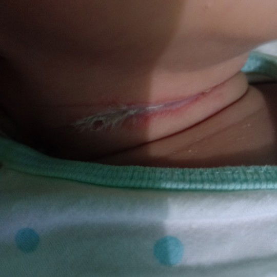 lecet di leher baby (lek-lek bahasa jawa nya)