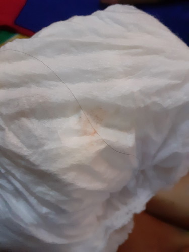 ลูกสาววัย5เดือน20วัน บางครั้งฉี่แล้วมีขุยๆสีส้มๆติดออกมาด้วย