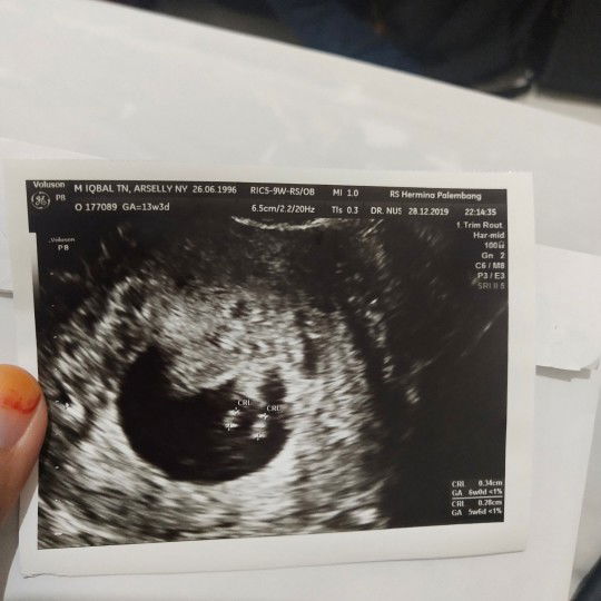 janin tidak berkembang dan dikuret