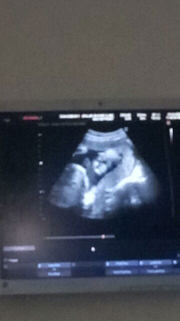 Normal Position si Baby