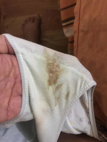 Brown discharge