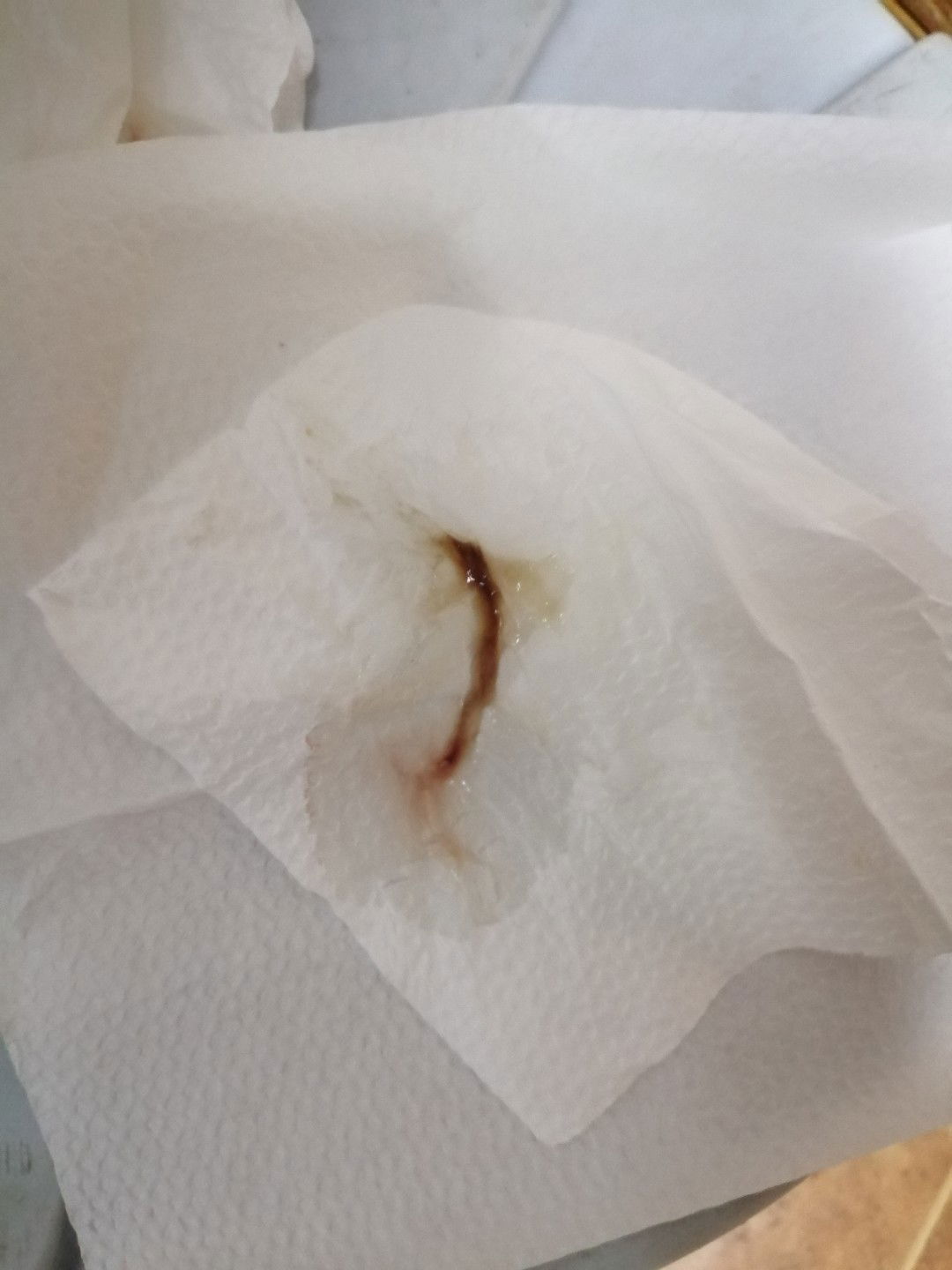 12-13 Weeks Fetal Death