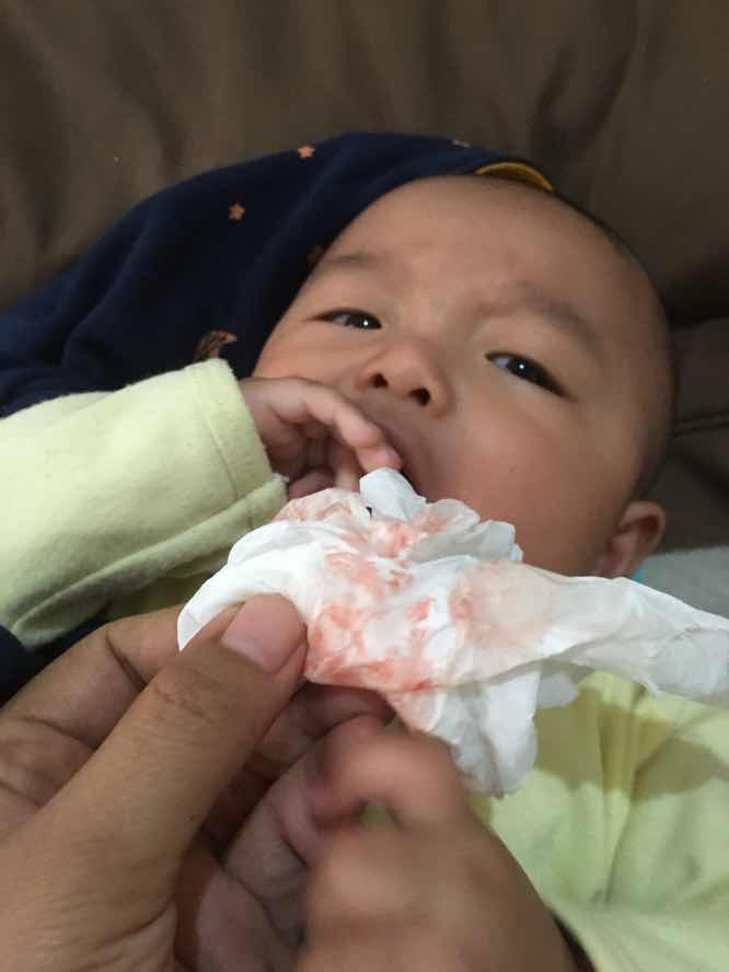 Gusi berdarah karna mainin jari