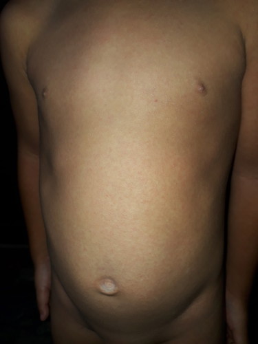 แม่ๆบ้านไหนน้องเคยเป็นผดผื่นแบบนี้บ้างคะ