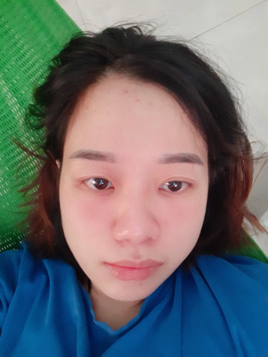 nổi mụn nhiều da quá khô
