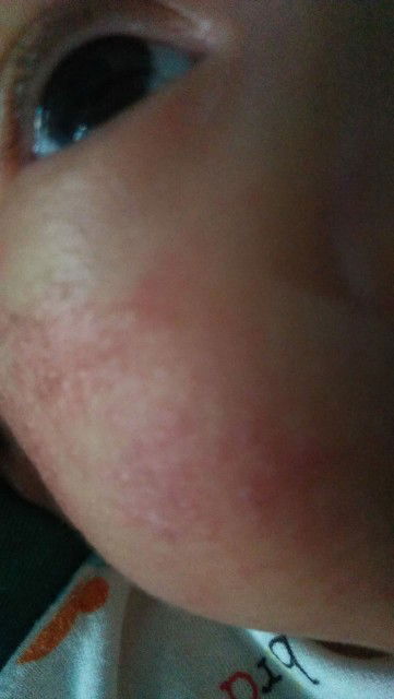 umur 1 bulan 15 kenapa pipi anak saya merah2 dan bintik3