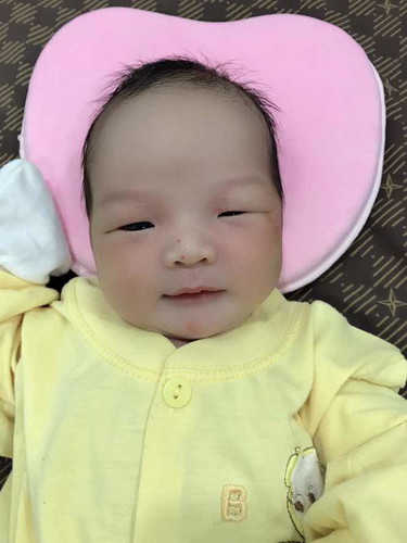 ผื่นขึ้นหน้า