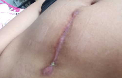 C-section