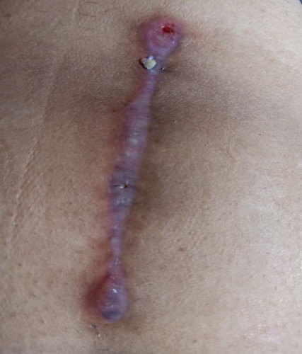 tahi / c- section