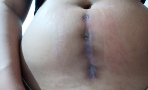 C SECTION SCAR