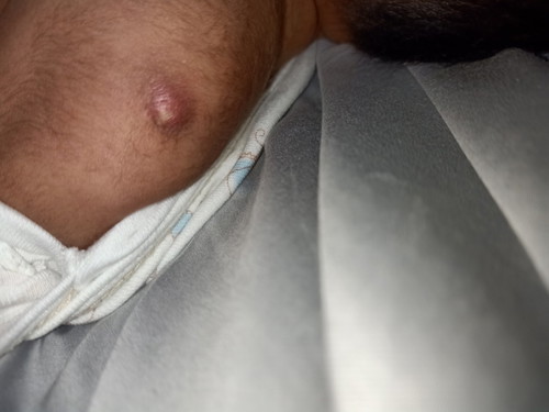 pigsa or dahil sa bgc injection?