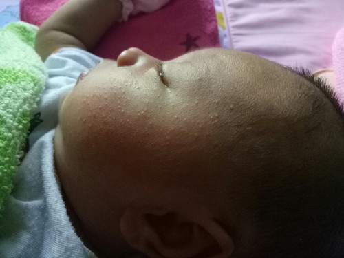 แม่ๆอยากทราบน้องเป็นผดผื่นแบบนี้ทำไงถึงหาย แล้วเป็นอันตรายใหม น้องพึ่งอายุได้27วันเองค่ะ