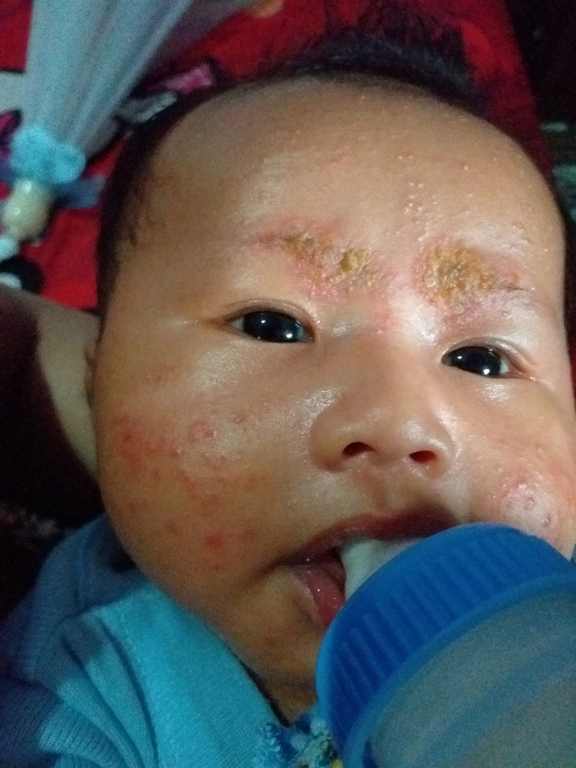 Biang keringat atau alergi