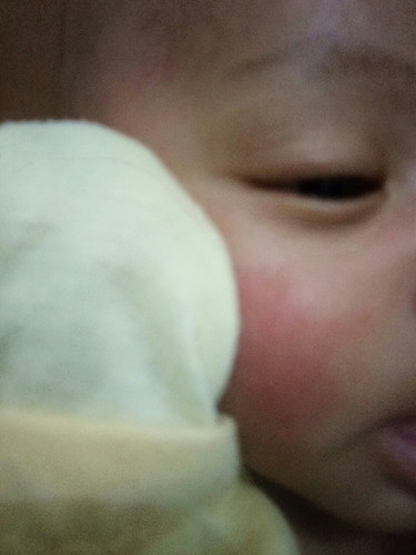 kemerahan dipipi pada bayi