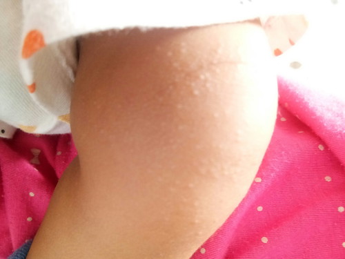 beruntusan di tangan dan kaki