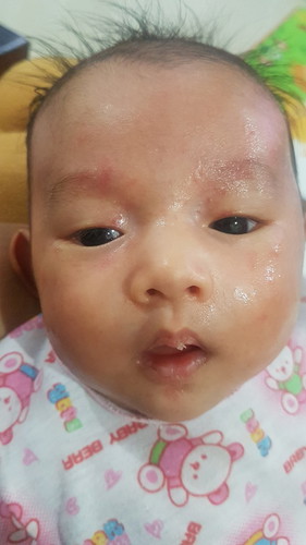 ลูกอายุ1เดือน มีเม็ดขึ้นแบบนี้เรียกว่าแพ้นมวัวไหมคะ