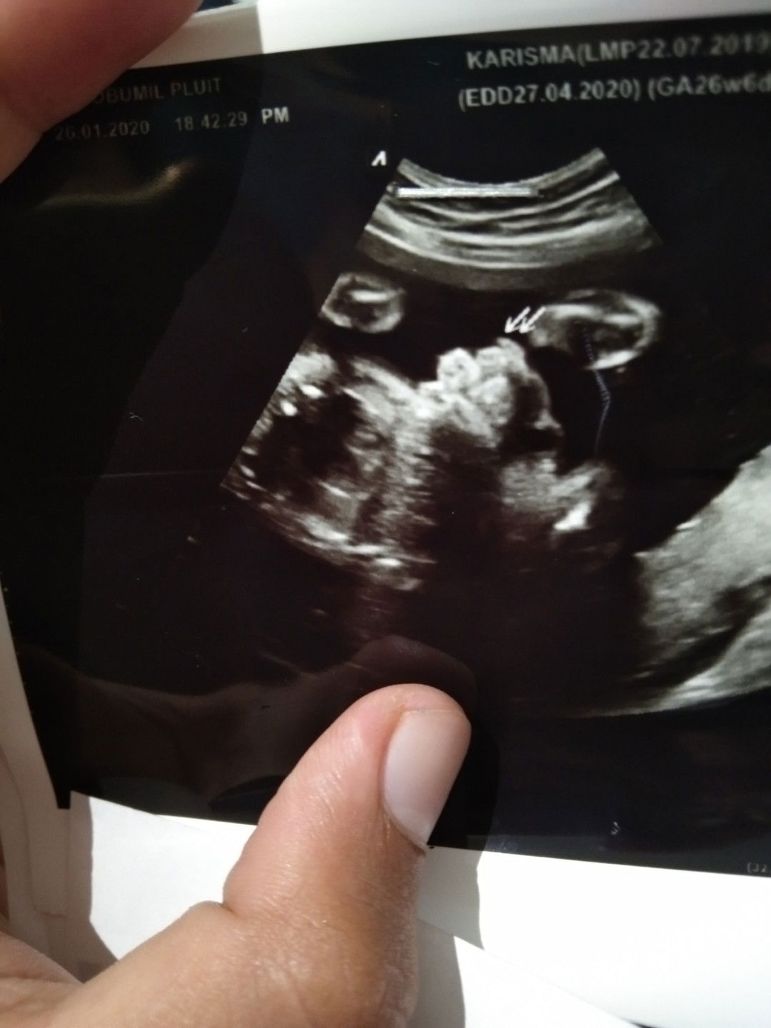 gumpalan di atas perut janin