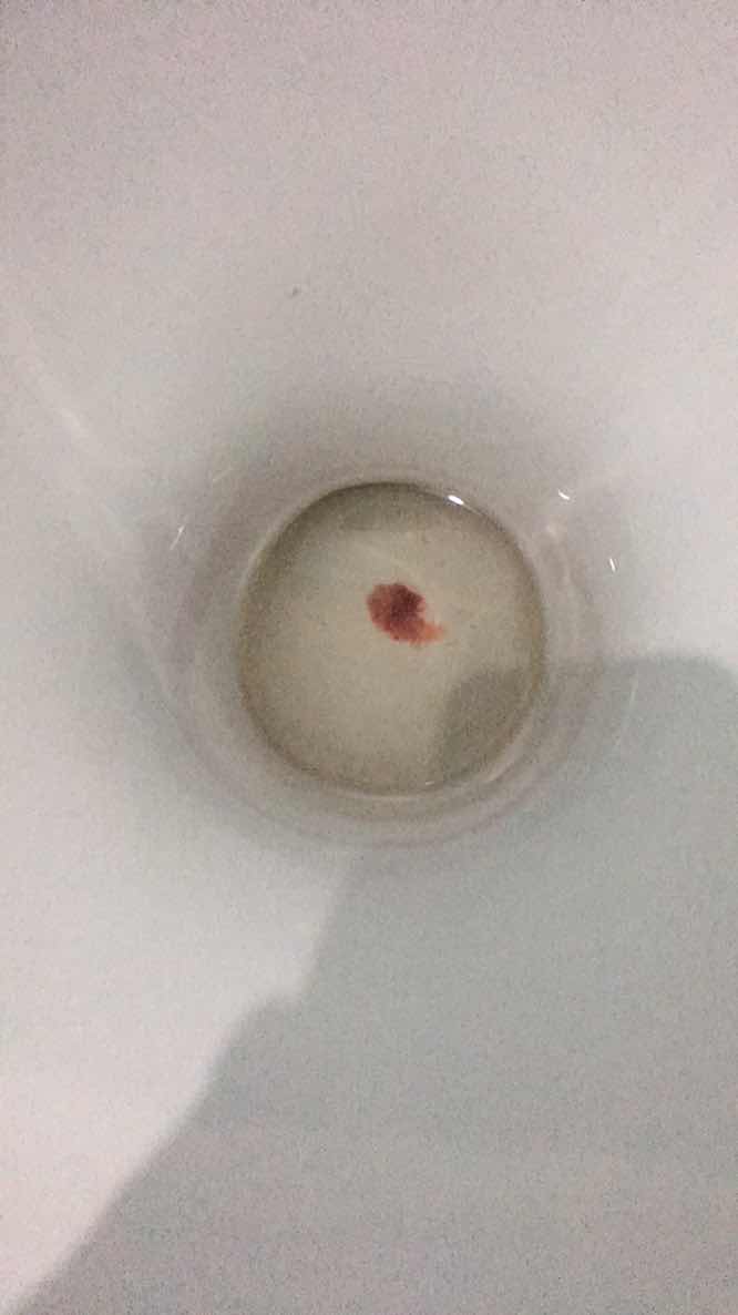 เมื่อวาน7โมงไปหาหมอมีเลือดออก ไม่มีอาการปวดท้อง ท้องแข็งแต่ไม่เจ็บ ตรวจปากมดลูกยังไม่เปิด นอนอยู่รพ ถึง10โมง หมอให้กลับบ้านเพราะยังไม่ปวดท้องมีแค่เลือดไหลเวลาเข้าห้องน้ำมดลูกก็ไม่เปิด